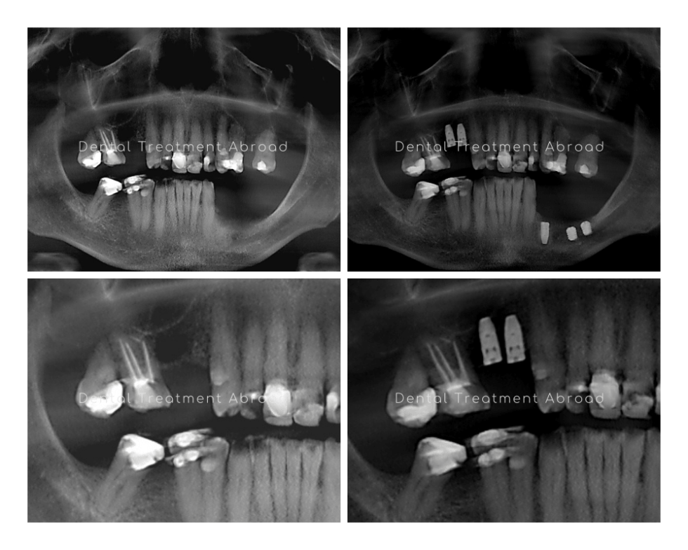 Dental Implant Solutions for Bone Loss Greatest Experts in Spain