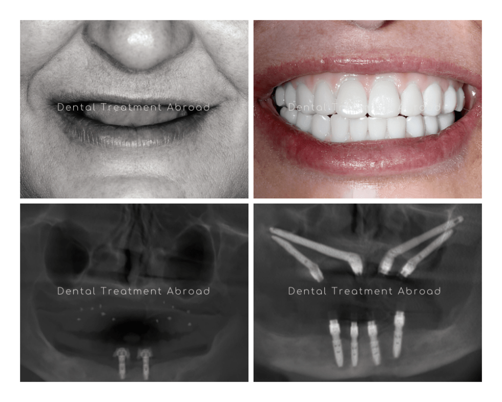 Dental Implant Solutions for Bone Loss Greatest Experts in Spain