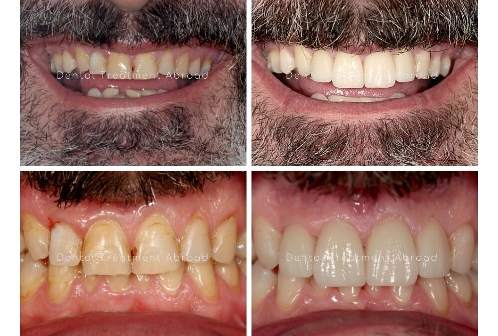 Zirconia Dental Crowns