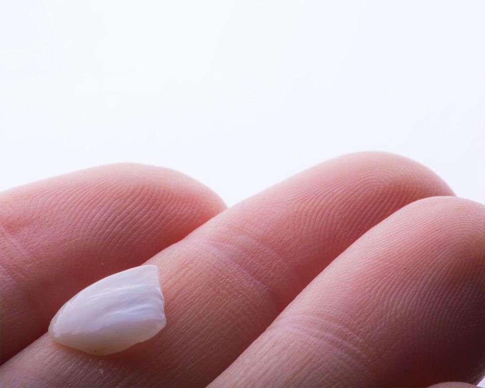 Veneers Dental Treatment In Spain