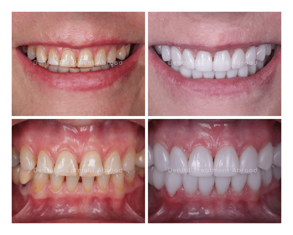 Veneers Dental Treatment In Spain