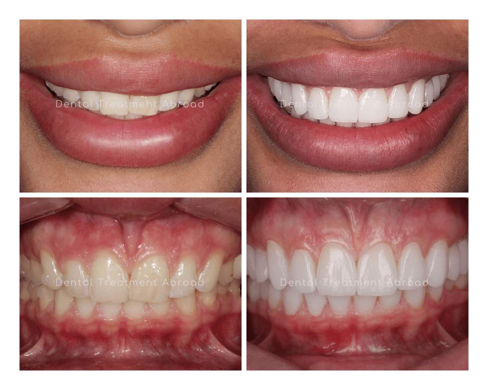 Veneers Dental Treatment In Spain